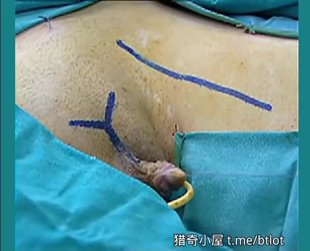 โปสเตอร์สำหรับ 变形手术女变男栽了一个阴茎
