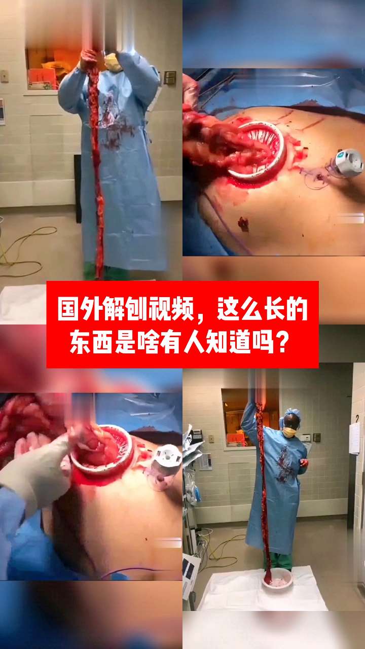 【暗网】国外解刨视频，这么长的应该是大肠吧 的封面