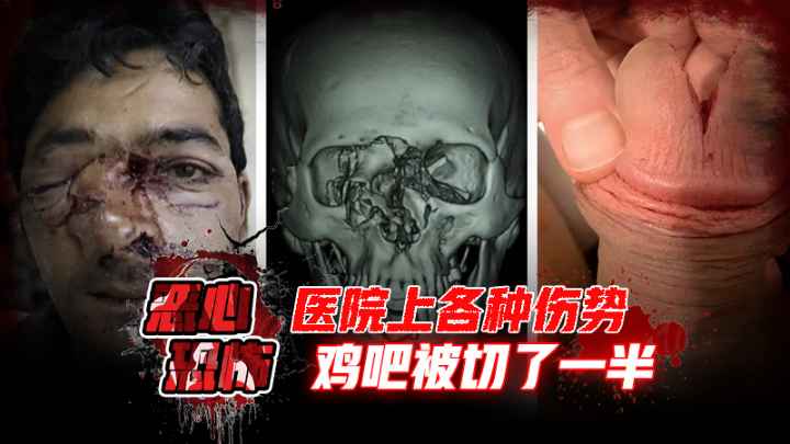 【恶心恐怖】医院上各种伤势，鸡吧被切了一半，看着都疼 포스터