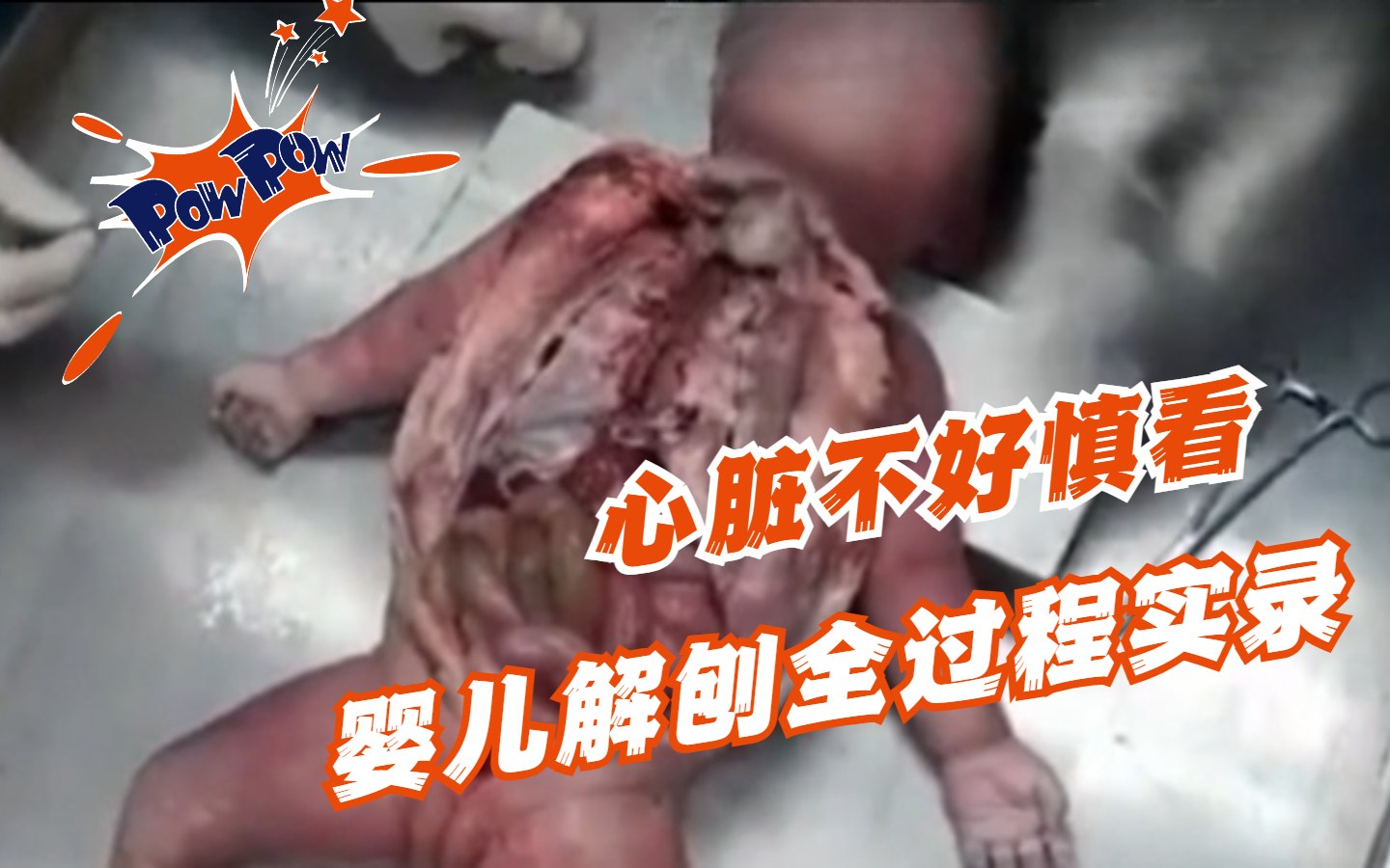 暗网-婴儿解刨全过程实录，心脏不好慎看！ 的封面